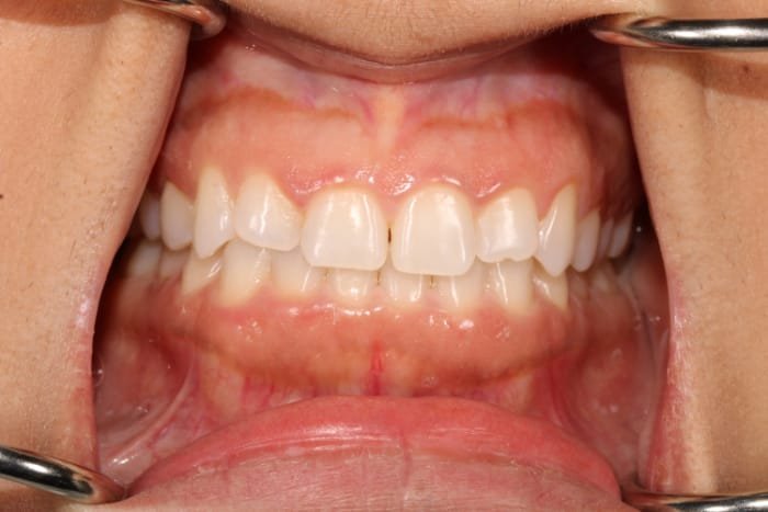 Pinhole Surgical Techniquie results in San Francisco with Dr. Samadian